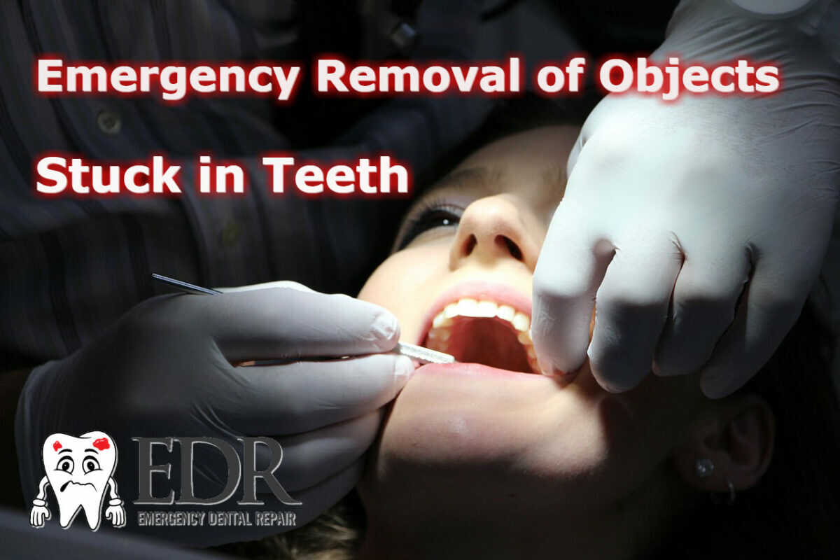 Emergency Removal Of Objects Stuck Between Your Teeth