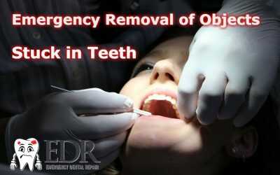 Emergency Removal Of Objects Stuck in Between Your Teeth
